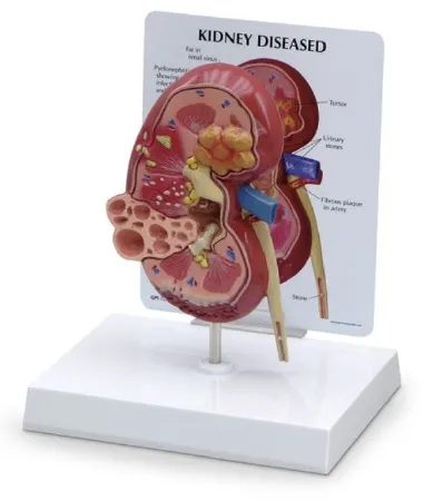 Nasco - GPI Anatomicals - SB46337 - Kidney Model w/ Pathologies GPI Anatomicals