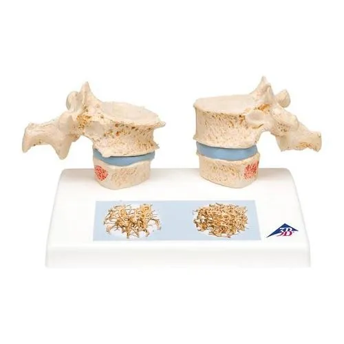 American 3B Scientific - A95 - Osteoporosis Model