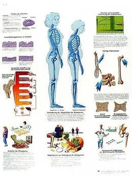 American 3B Scientific - From: VR3121L To: VR3121UU - Osteoporosis Chart_ES_L