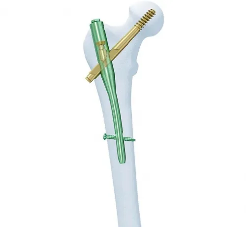 Synthes - 456.484s - Synthes 12mm/130 Deg Ti Cannulated Troch Fixation Nail 440mm/Right-Sterile